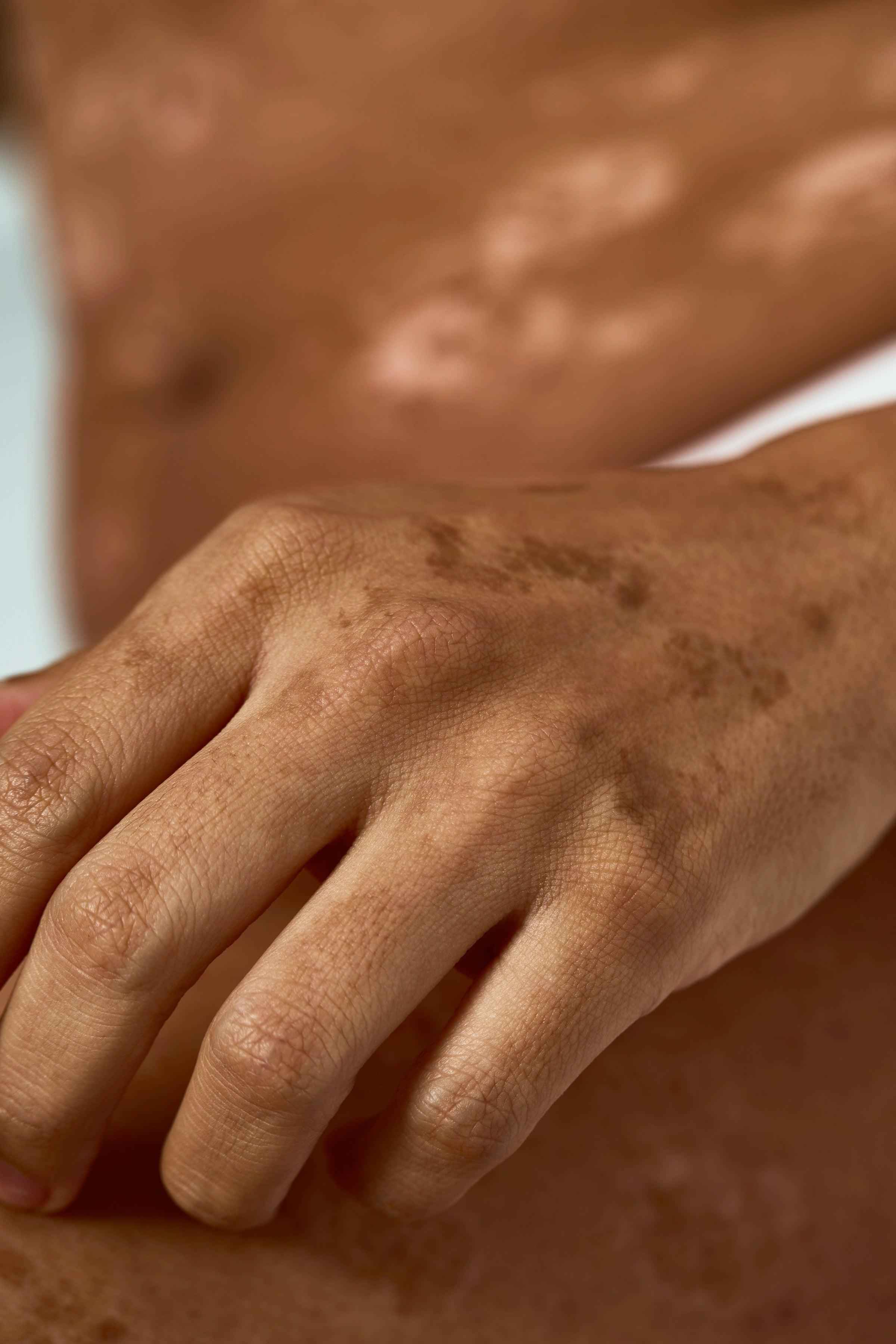 Flawless Radiance: Nurturing Impure Skin With NamoMonk - NamoMonk